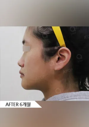 After