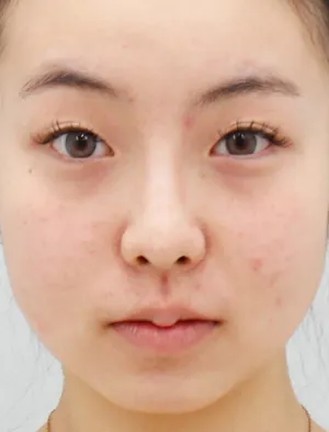 Before