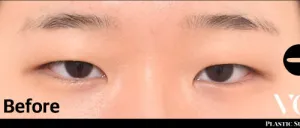 Before