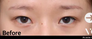 Before