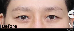 Before
