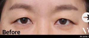 Before