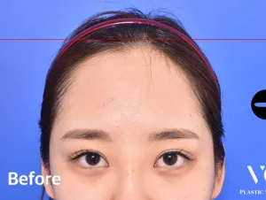 Before