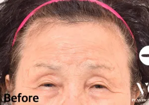 Before