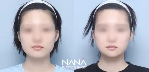 Before