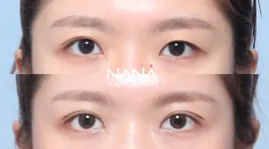 Before