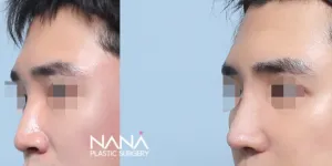 Before