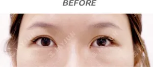 Before