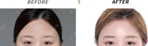 Before