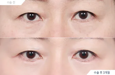 Before & After