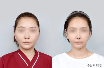 Before & After