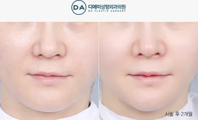 Before & After