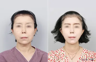 Before & After