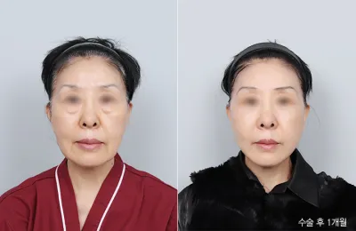Before & After