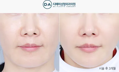 Before & After