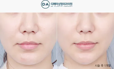 Before & After