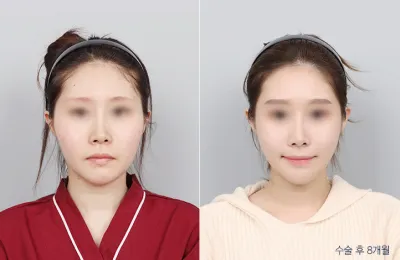 Before & After