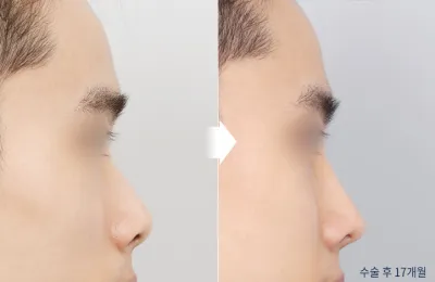 Before & After