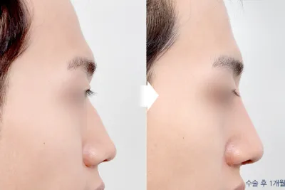Before & After