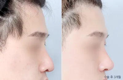 Before & After