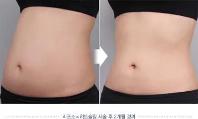 Before & After