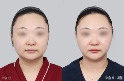 Before & After