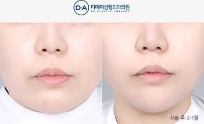 Before & After