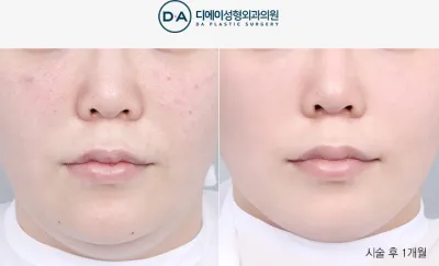 Before & After