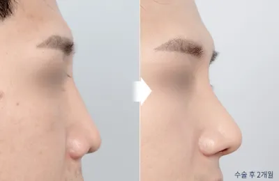 Before & After
