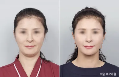 Before & After