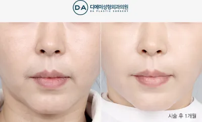 Before & After