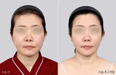 Before & After