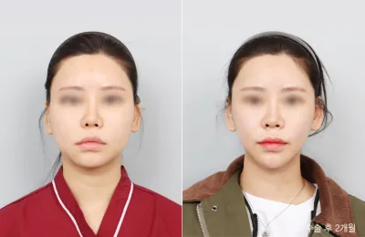 Before & After