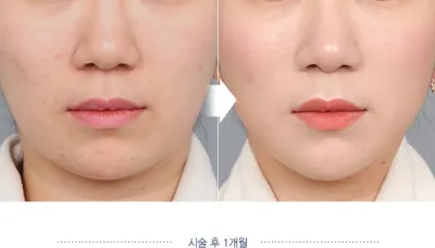 Before & After