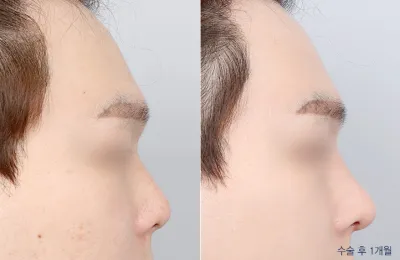 Before & After