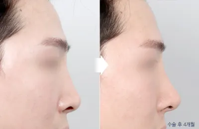 Before & After