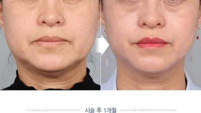 Before & After