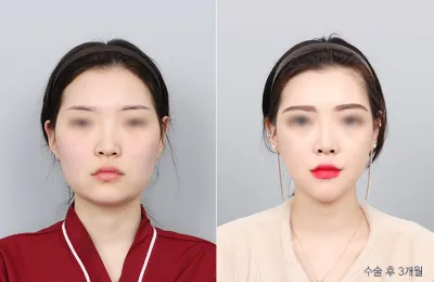 Before & After