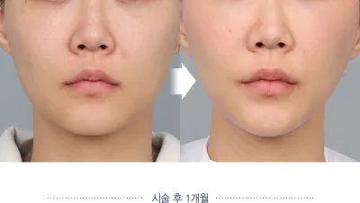 Before & After