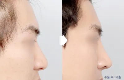 Before & After