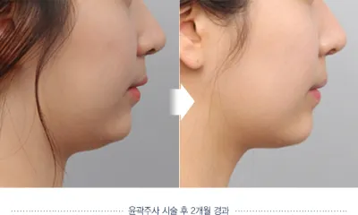 Before & After