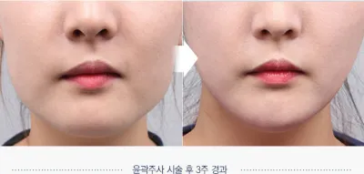 Before & After
