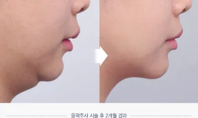 Before & After