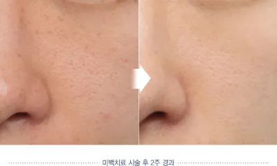 Before & After