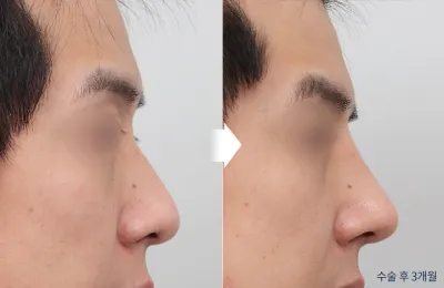 Before & After