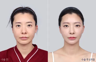 Before & After