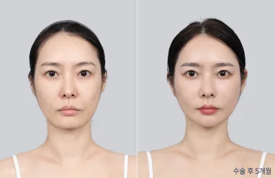 Before & After