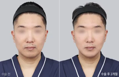 Before & After