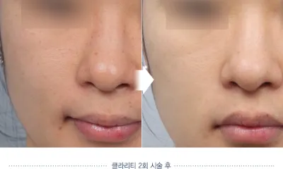 Before & After