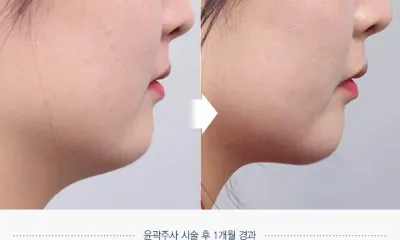 Before & After